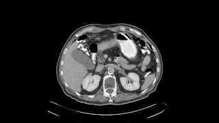 Scirrhous gastric adenocarcinoma signet ring cell type [upl. by Mw]