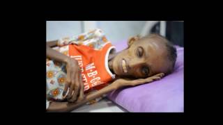 SEE IT Heart wrenching photos document severe malnutrition in Yemen as bloody civil war rages on [upl. by Eanad]