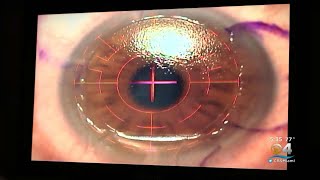 The EyePopping Reports Linked To LASIK Complications [upl. by Ynnavoig563]