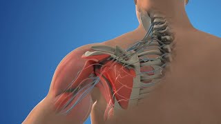 Posterior Cervical Decompression Surgery  Medical animation video [upl. by Kcirdor664]