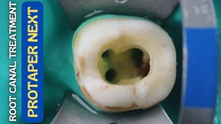 Root Canal Treatment in Mandibular Molar ⚪️ Protaper Next 🔵 Step By Step Demonstration [upl. by Valente727]