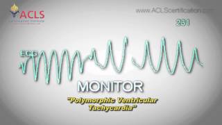 Polymorphic Ventricular Tachycardia PolyVTach by ACLS Certification Institute [upl. by Cletus291]