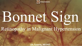 Bonnet Sign Retinopathy in Malignant Hypertension [upl. by Alleoj110]