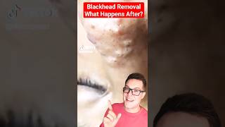 What Happens To The Hole  BLACKHEAD REMOVAL Update shorts [upl. by Nairrod]