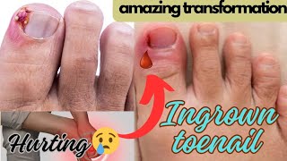 quot1 Year of Ingrown Toenail Pain My Struggle and How I Found Reliefquotnailsingrowingnailnaildesign [upl. by Nolan]