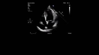 Echocardiography Study [upl. by Carolann]