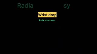 wrist drop radial nerve palsy anatomy medical doctors youtubeshorts [upl. by Jock]