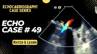 Echocardiography Case 49 Echo Spot Diagnosis Series  Cardiology TOACS [upl. by Alda]