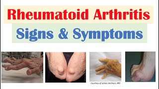 Rheumatoid Arthritis RA Signs amp Symptoms amp Associated Complications [upl. by O'Neill]