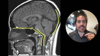 Chiari Malformation amp Cervical Instability a Deep Dive  Upper Cervical Chiropractor Spokane [upl. by Ykvir]