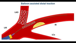 Intracoronary stent loss cardiology cardiologyfellow unam anahuac anatomy complication [upl. by Christabella]