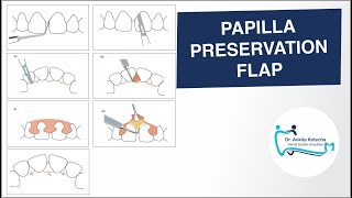 PAPILLA PRESERVATION FLAP PERIODONTAL FLAP SURGICAL TECHNIQUE DR ANKITA KOTECHA [upl. by Garner]