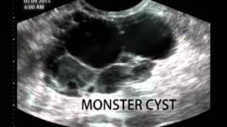 Monster Cyst [upl. by Alisander202]