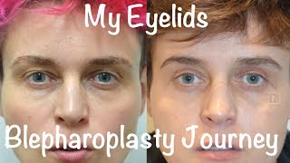 My Upper amp Lower Blepharoplasty experience with Sedation Anaesthesia…recovery story with photos [upl. by Gambrell]