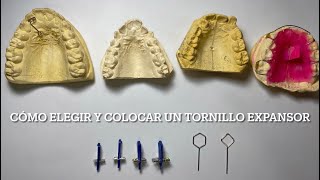 Cómo elegir y colocar un Tornillo Expansor [upl. by Marillin]