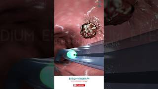 Know About Brachytherapy ↪ 3D Medical Animation Brachytherapy InternalRadiationTherapy [upl. by Coop59]