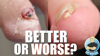 BEFORE amp AFTER INGROWN TOENAILS NAIL TUMOR AND INFECTED NAILS [upl. by Haodnanehs]