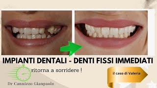 Impianto dentale su un singolo dente  Studio Cannizzo Milano [upl. by Valenba751]