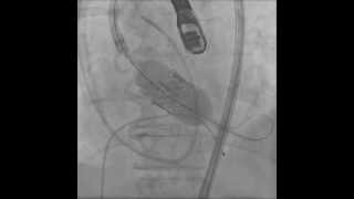 TAVRTrascatheter Aortic Valve ReplacementTransfemoral Deployment [upl. by Yelbmik]