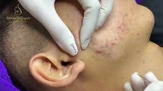 Loan Nguyen Acne Treatment 16188 [upl. by Ttocserp]