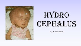 Hydrocephalus  types causes signs and symptoms investigation treatment [upl. by Nesbitt]