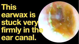 This earwax is stuck very firmly in the ear canalear wax removal  ear cleaning  ASMR relax [upl. by Siroved779]