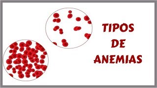 TIPOS DE ANEMIAS  Sinais Sintomas e Tratamento [upl. by Anaer274]