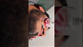 Hijama on face [upl. by Marco]