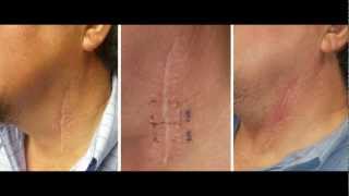 Deep FX CO2 laser treatment of neck scar by Dr Joe Niamtu III [upl. by Hawken]