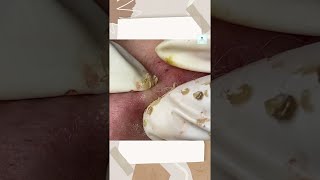 Big Cystic Acne Blackheads Extraction Blackheads amp Milia Whiteheads Removal Pimple Popping shorts [upl. by Nnalorac]