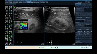 IQ 287 KIDNEY FIBROSIS ECHOPAC ANALYSIS ULTRASOUND 4 [upl. by Odlaner]