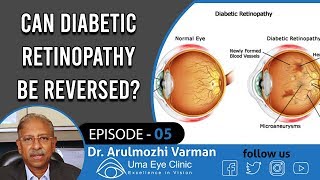 Diabetes Retinopathy  Can Diabetic Retinopathy Be Reversed  Dr Arulmozhi Varman  EPI 05 [upl. by Leodora800]