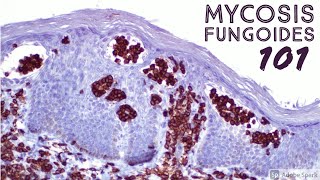 Mycosis Fungoides 101 Cutaneous Tcell Lymphoma CTCL for Dermatopathology Pathology Dermatology [upl. by Intyre]