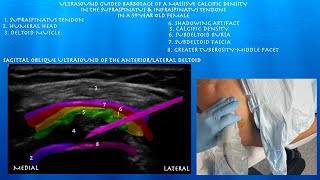 Ultrasound Guided Barbotage of Massive Calcific Tendinitis Supraspinatus and Infraspinatus Tendons [upl. by Fianna]