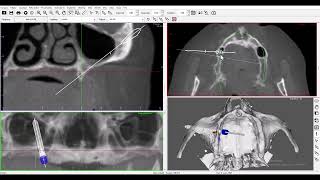 Planejamento de implantes Zigomáticos e no Pterigóideo [upl. by Strickler]