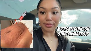 Microneedling on Stretch Marks  Vlog pt 1 [upl. by Haneehs]