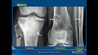 Imaging of Bone Tumors [upl. by Sonstrom]