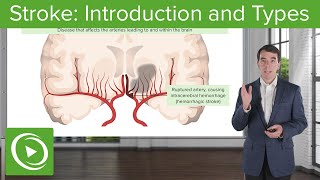 Stroke Introduction and Types  Clinical Neurology [upl. by Elizabet]