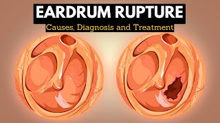 The Science Behind Eardrum Rupture Explained in Simple Terms [upl. by Idrahs]