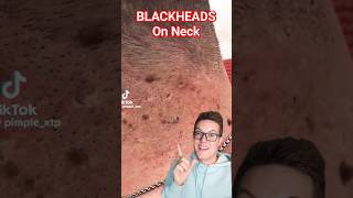 Crazy BLACKHEAD REMOVAL FROM NECK  Perfection shorts [upl. by Tjaden]