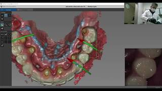 Scanner Intraoral CS 3600  Protocolo de escaneamento [upl. by Akila334]