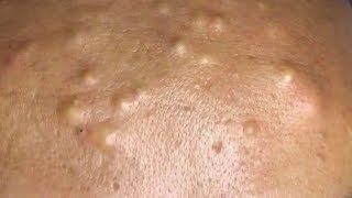 How To Remove Blackheads And Whiteheads On Face Easy 122 ✦ Dr Laelia ✦ [upl. by Malti]