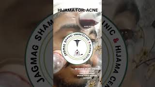 HIJAMA FOR FACE ACNE facecupping [upl. by Eseela587]