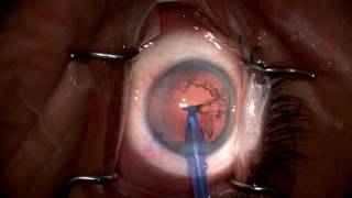 Basic Monofocal IOL Cataract Surgery  Brooks Eye Associates [upl. by Lionel]