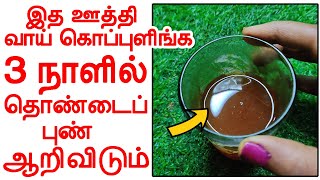 3 நாளில் தொண்டைப்புண் ஆற இத ஊத்தி கொப்புளிங்க  thondai punnu home remedies in tamil [upl. by Tabitha]