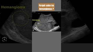 Porque salen los hemangiomas en el hígado [upl. by Arlyn]