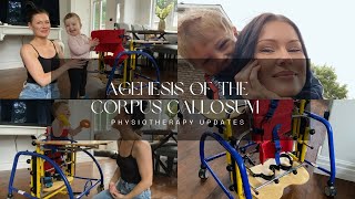 Agenesis of the Corpus Callosum  Physiotherapy Updates [upl. by Ahsiekel]