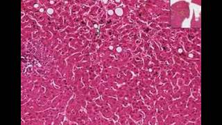 Histopathology LiverCholestasis [upl. by Gnoc]