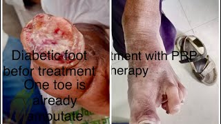 More than 6months Unheald wound for diabetic footPRP therapy… [upl. by Maryrose]