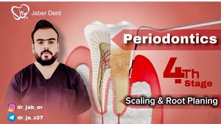 Periodontics   Scaling amp Root Planing [upl. by Chastity]